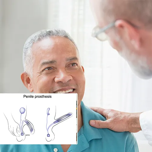 Choosing  Urological Consultants of Florida 
for Malleable Penile Implant Procedures